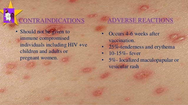 Russian Porn Vidoes Adult Varicella Vaccine